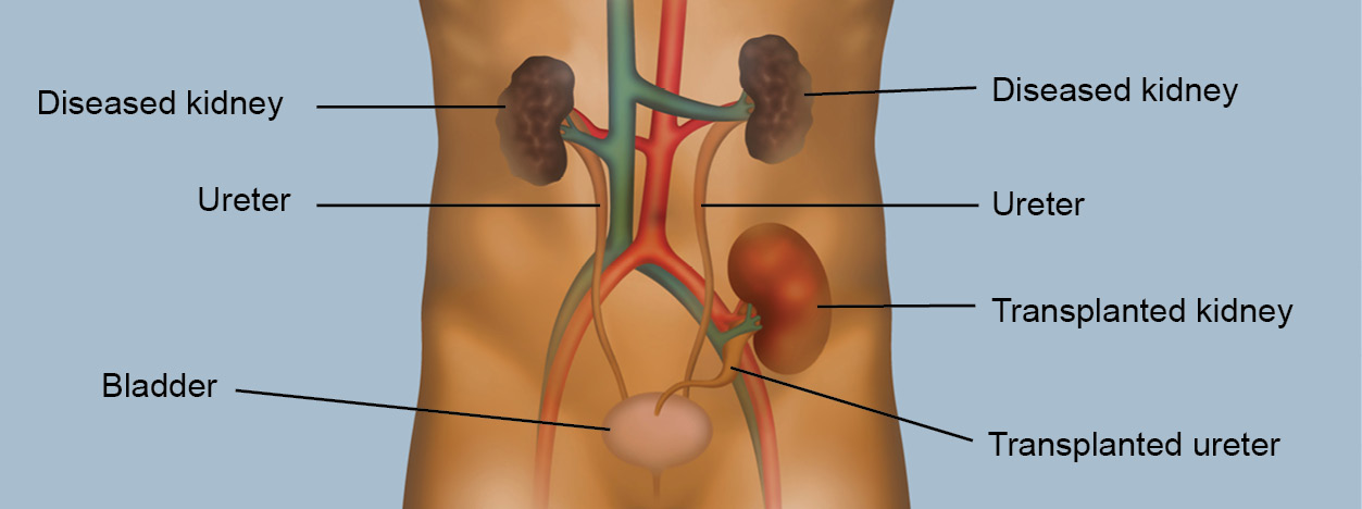 KidneyTransplant.